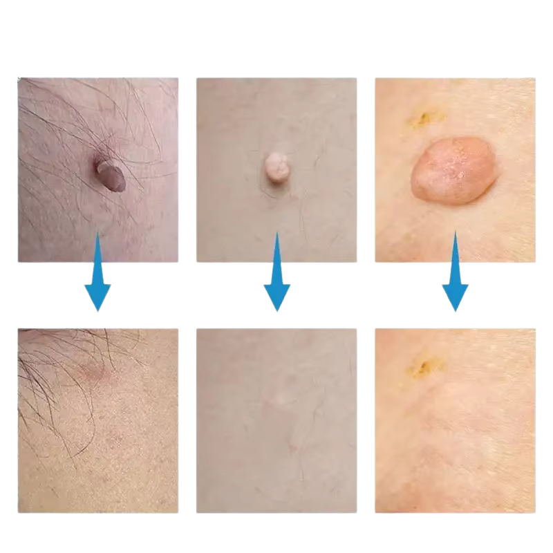 Komplet za odstranjevanje madežev SkinSilence™
