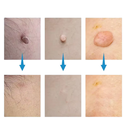 Komplet za odstranjevanje madežev SkinSilence™
